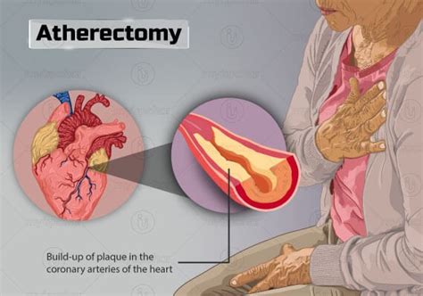 Atherectomy What Is It Types Procedure And Recovery