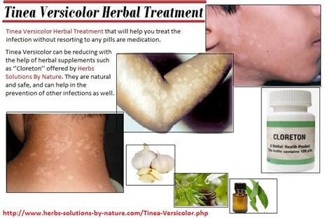 Herbal Treatment Of Tinea Versicolor Yeast Infection Herbs Solutions