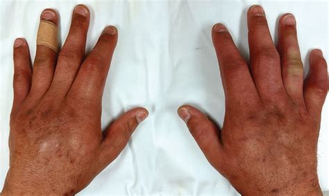 Puffy Hand Syndrome Cleveland Clinic Journal Of Medicine
