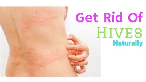 How To Get Rid Of Hives Fast 2 Best Home Remedies To Get Rid Of Hives