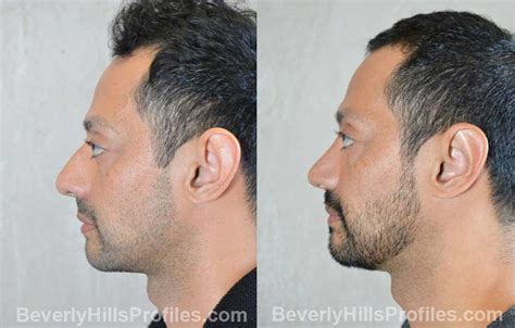 Rhinoplasty Before And After Photos Beverly Hills La Rhinoplasty