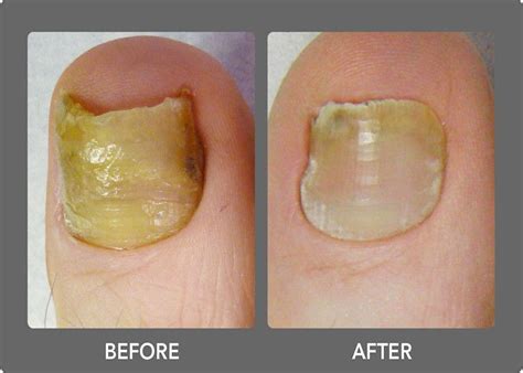 Laser Toenail Fungus Treatment Removal In West Palm Beach Before