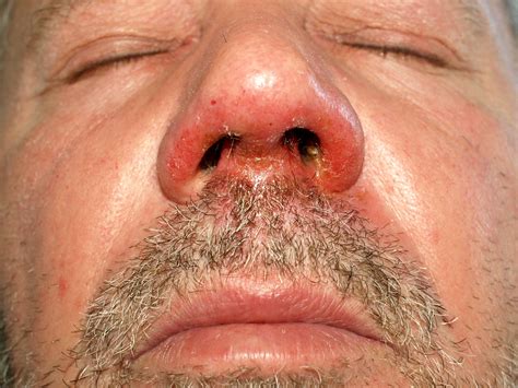 If he did have syphilis, another question arises: File:Impetigo Nase.jpg - Wikimedia Commons