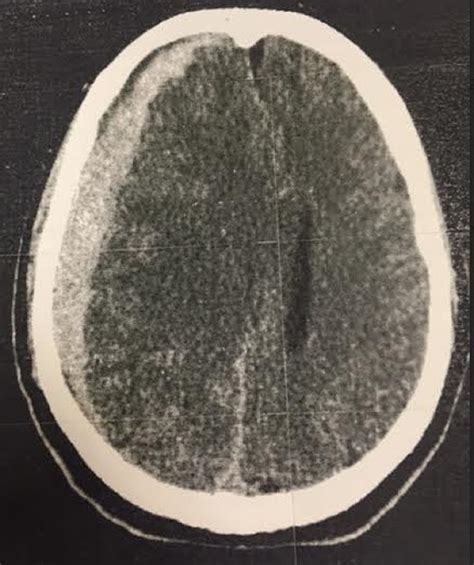 Case Study A Subdural Hematoma After A Fall The Clinical Advisor