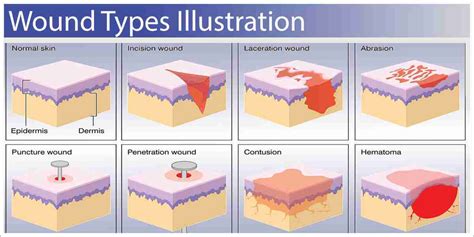 51 Lesson Types Of Wounds Siren Training