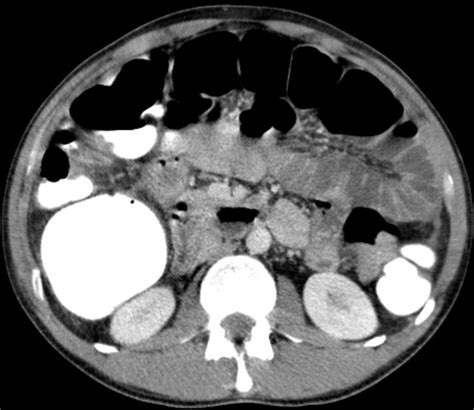 Looking for online definition of colon ascendens in the medical dictionary? Colon - Karzinom: Diagnostik