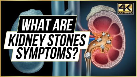 What Are Kidney Stone Symptoms 5 Major Causes Of Kidney Stone Pain