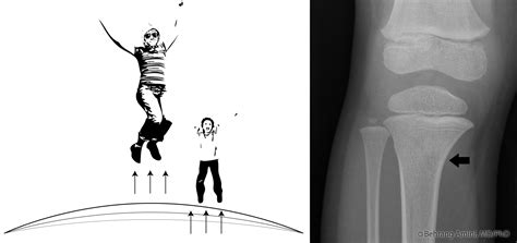 Roentgen Ray Reader: Trampoline Fracture of the Proximal Tibia