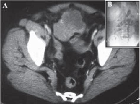 A Preoperative Ct Scans Showing Pelvic Mass Contrast Enhanced Ct