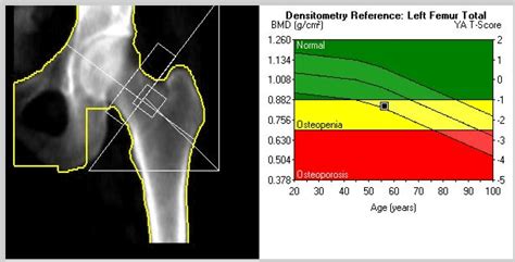 During a bone mineral density test, you will lay on your back on a table while a scanner arm moves back and forth over the part of your body being studied. DXA Tests: What you must know