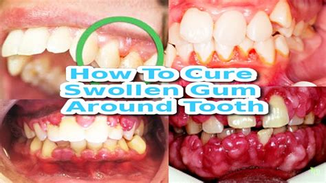 How To Cure Swelling Gums Fast How To Cure Swollen Gum Around Tooth