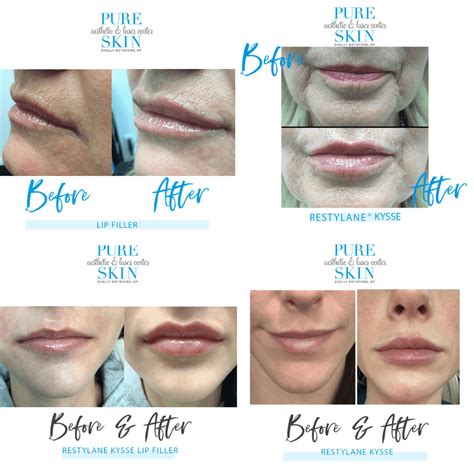 Restylane On Lips Before And After