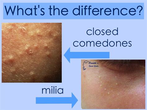 A comedo is a clogged hair follicle (pore) in the skin. The Acne Whisperer: Adult Acne in the Presence of ...