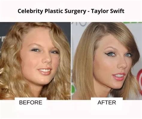 Celebrity Plastic Surgery 51 Before And After Images Fabbon