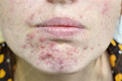 Acne Vulgaris On The Chin Stock Image C0151608 Science Photo Library