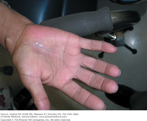 Hand Eczema Basicmedical Key