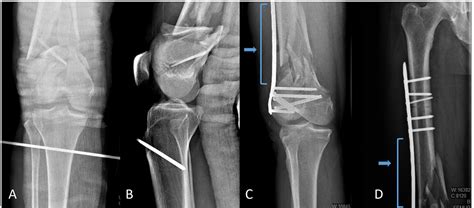 Cureus Treatment Of Periarticular Fractures Of The Knee Using The