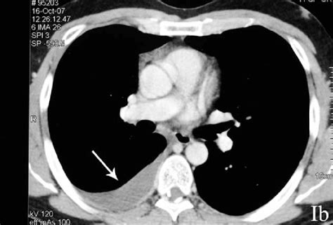 Ct scan of the chest of a patient with large loculated pleural effusion in his left thoracic cavity. B.-CT scan showing the presence of a pleural effusion on ...