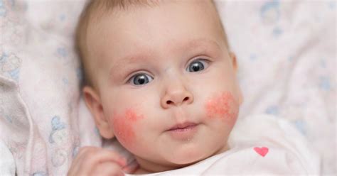 Eczema In Babies And Children Netmums