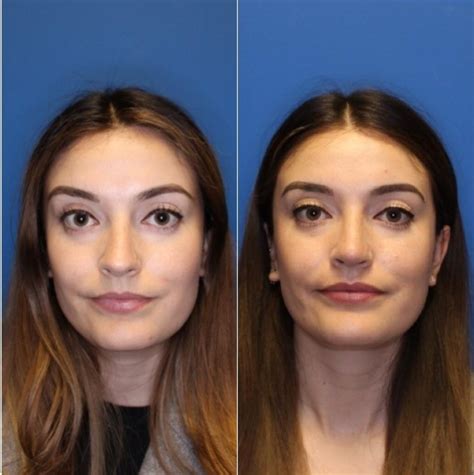 Nose Surgery Before And After Photos Patient 234 San Francisco Ca