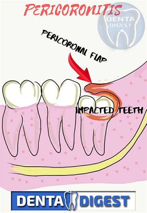 Pericoronitis In 2021 Wisdom Tooth Infection Tooth Infection Wisdom