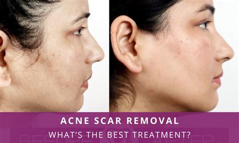 Acne Scar Removal Treatment Types Cost Recovery