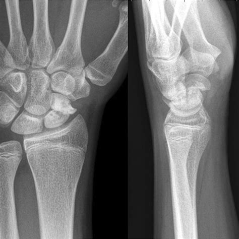 Pa And Lateral Radiographs Demonstrating Scaphoid Non Union And