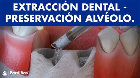 Conservación Del Alvéolo Después De La Extracción Del Diente Vídeo 3d De Clinica Médico Dental