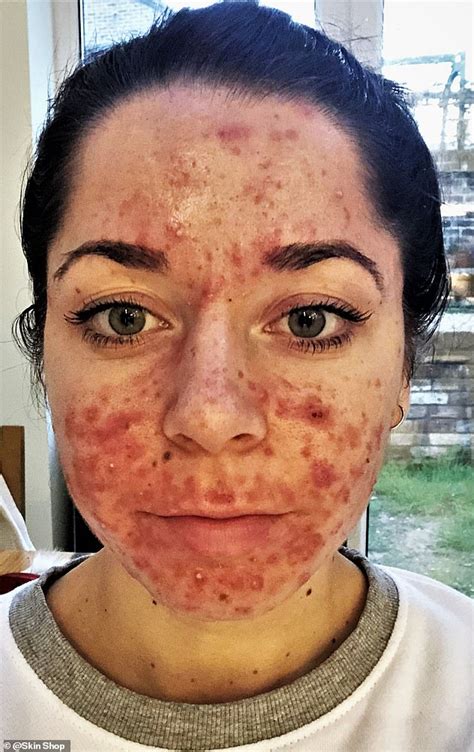 Personal trainer who had the 'worst acne ever seen' shares her striking