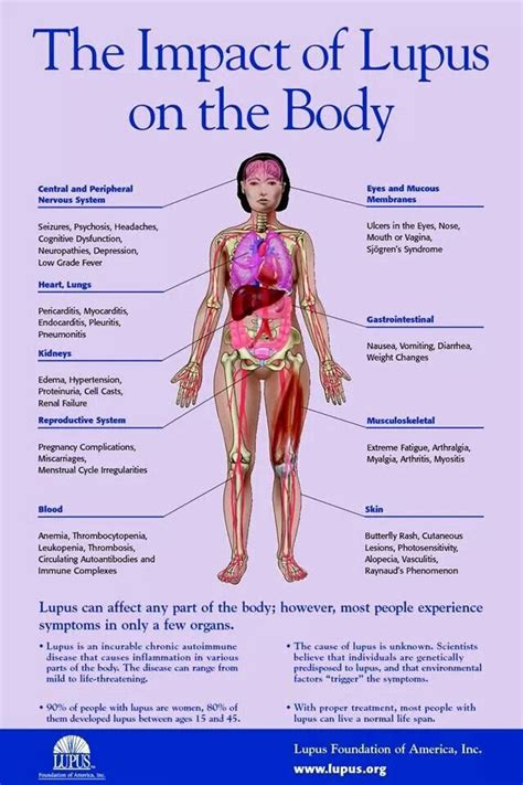 Lupus Diagram