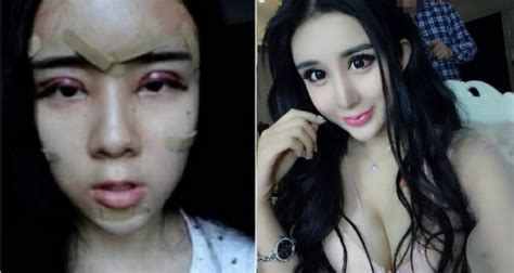 Plastic Surgery Before And After China