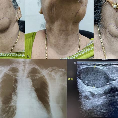 Ac Patient With Multiple Matted Lymph Nodes On Left Side Level Ib