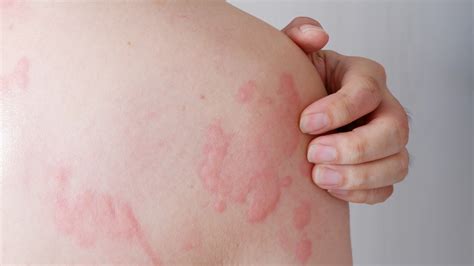 Hives Versus Rash What S The Difference