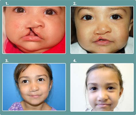 Cleft Palate Repair Before And After