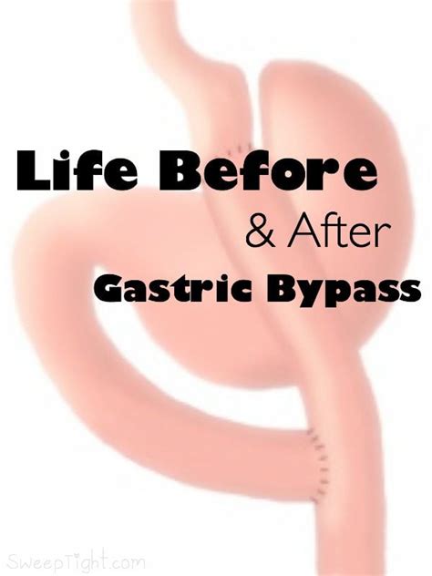 Life Before And After Gastric Bypass