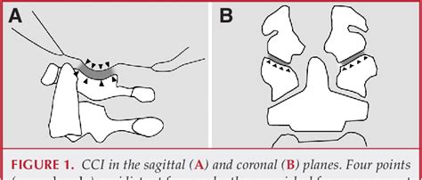 Atlanto‐occipital Dislocation—part 2 The Clinical Use Of Occipital