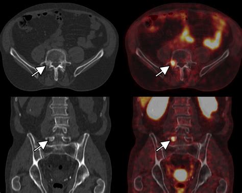 Le Psma Petct En Cas De Cancer De La Prostate