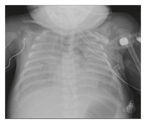 Chest X Rays Taken On Admission A On The Day Before Cannulation And