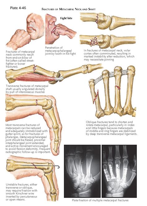 Fracture Of Metacarpals Pediagenosis