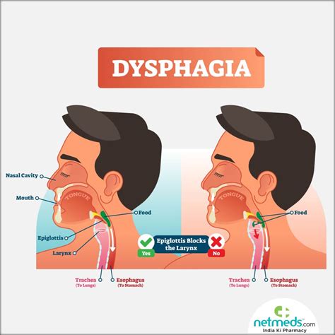 Dysphagia Causes Symptoms And Treatment Netmeds