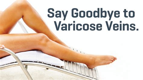 Dont Let Varicose Veins Get You Down Treatment Is Available Dr