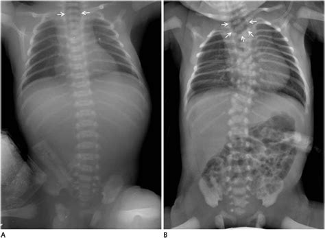 Interpretation Of Neonatal Chest Radiography