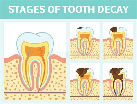 Tooth Decay Stages Stock Illustration Illustration Of Disease 82408196