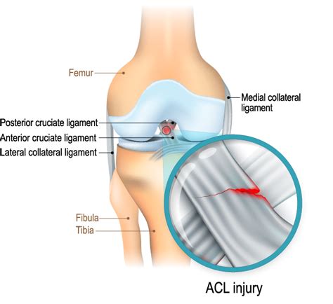 acl injuries why are they so common in australia