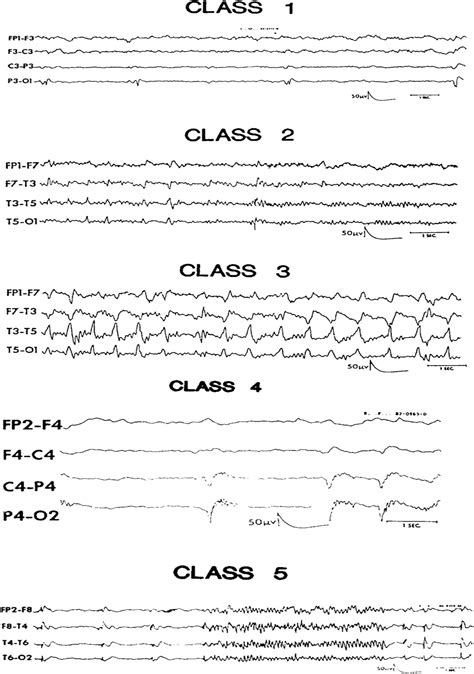 Lateralized Periodic Discharges A Literature Review Journal Of