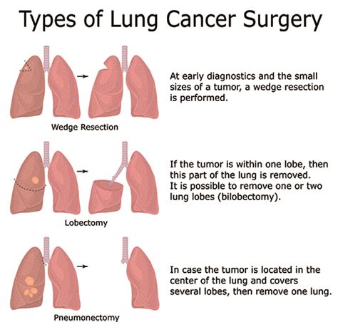 Surgical Options For Lung Cancer Stony Brook Cancer Center