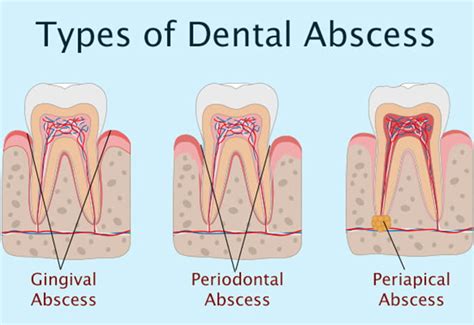 All About Dental Abscesses Dentist For Life