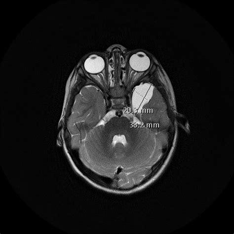 Arachnoid Cyst Middle Cranial Fossa Image