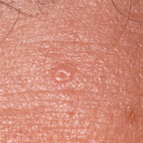 1000 Images About Skin Lesions And Conditions On Pinterest Plugs