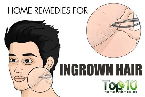 Most remedies focus on dealing with the discomfort that ingrown hairs can cause. Home Remedies for Ingrown Hair | Top 10 Home Remedies